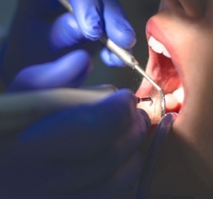 Dental Calculus Cleaning