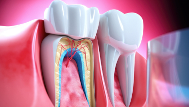 Root Canal Treatment