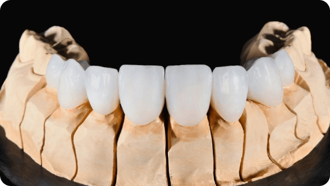 Porcelain Veneer