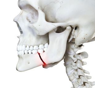 Mandibular Fractures