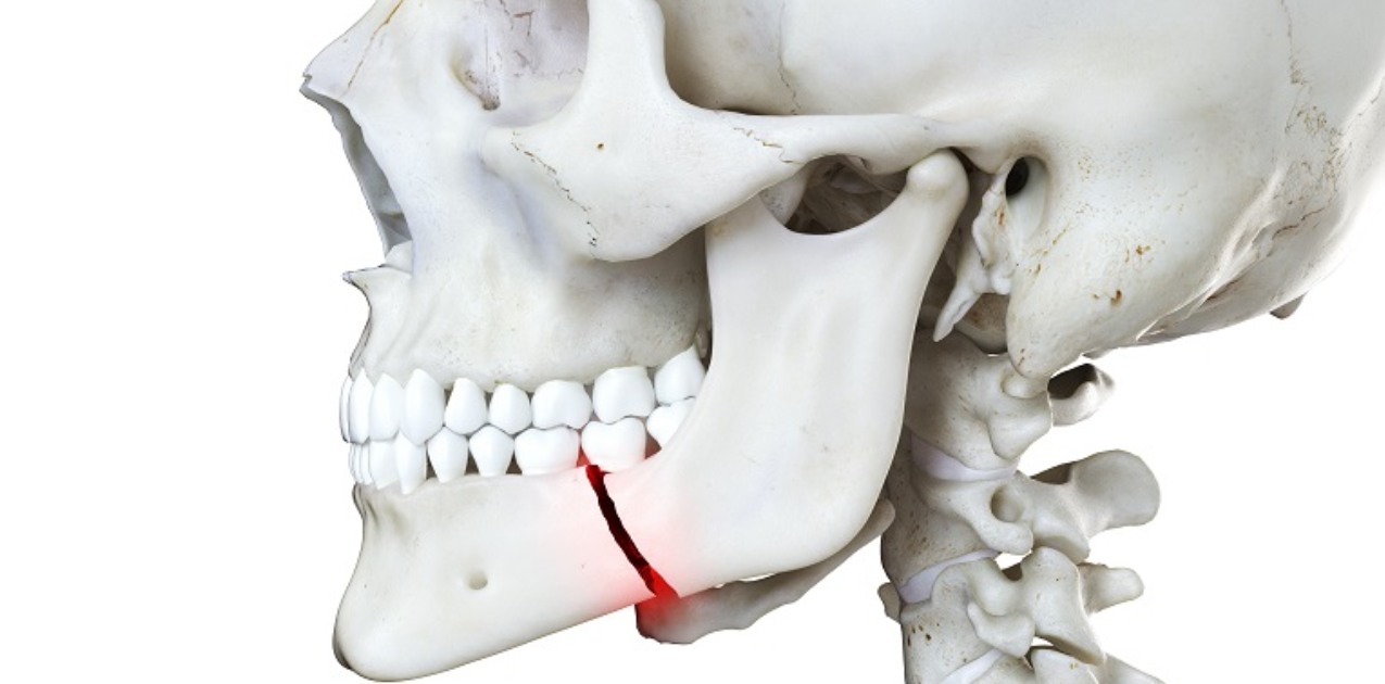 Mandibular Fractures