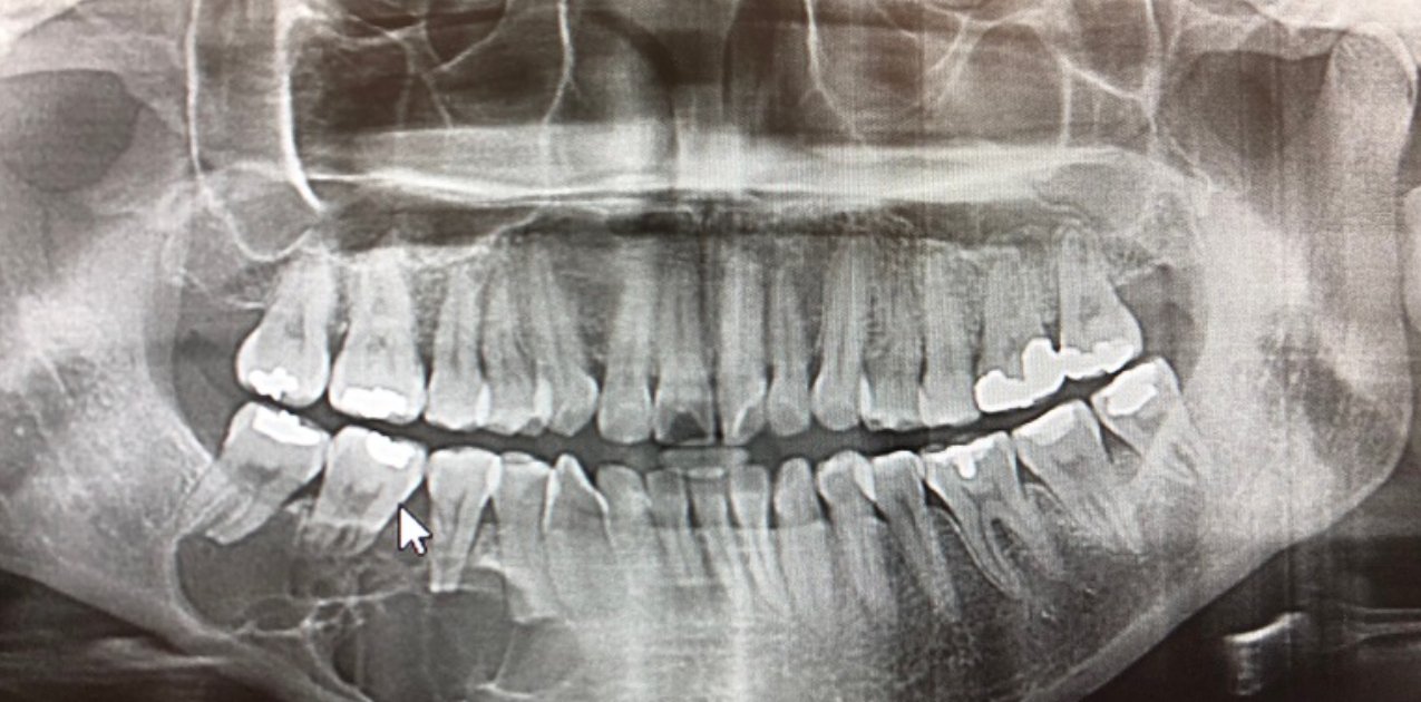 What Are Jaw Cysts?