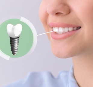 Things To Note About Oral Implant Treatment