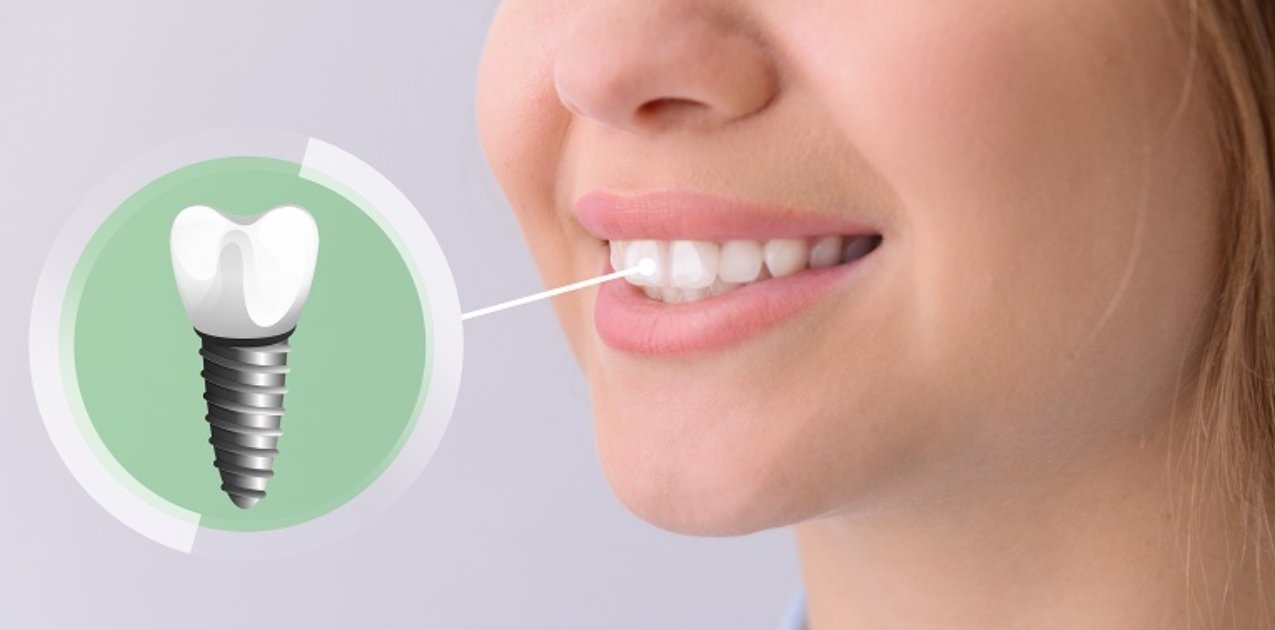 Things To Note About Oral Implant Treatment