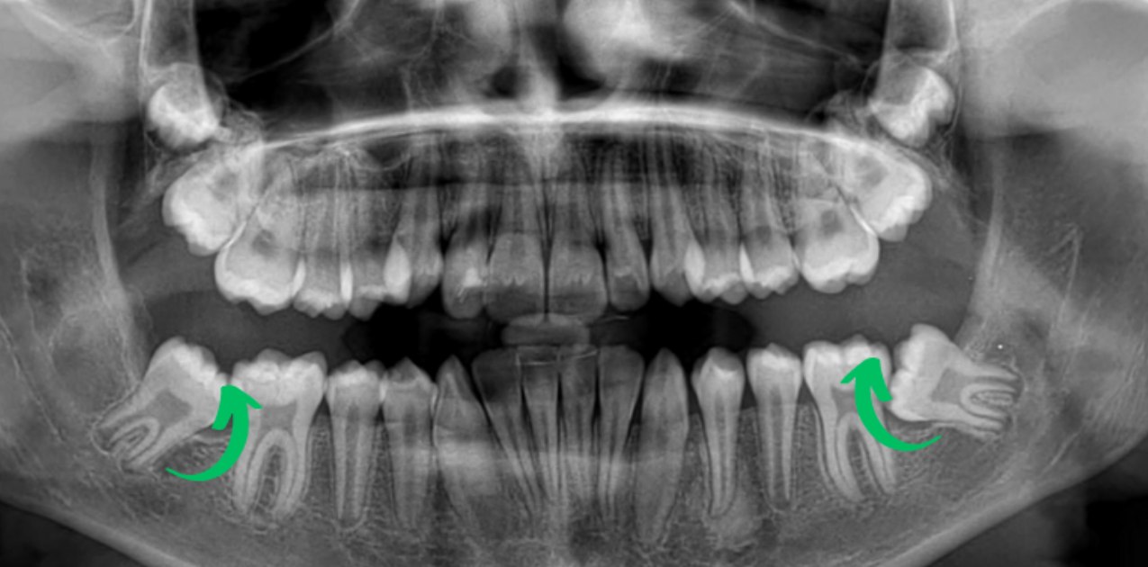 What is Orthodontic Mini Screw Application?