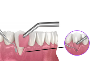 What is Free Gingival Graft Application?