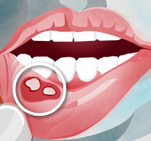 Do Not Neglect Chronic And Non-Healing Mouth Wounds